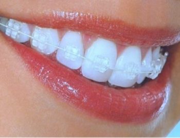 Clear Braces, Invisible Braces, or Invisalign